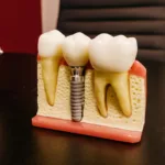 Full Mouth Dental Implants Bronx NY Alternatives: Everything You Need to Know