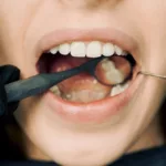 The Definitive Guide to Dental Crown Permanence