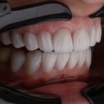 5 Stunning Tooth Crown Transformations: Before and After Revealed